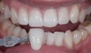 Пациент Карина – профессиональное отбеливание зубов