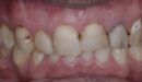 Пациент Вячеслав – установка виниров на зубах верхней челюсти