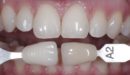Пациент Дарья – профессиональное отбеливание зубов системой ZOOM4