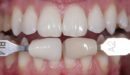 Пациент Светлана – отбеливание зубов системой Phillips Zoom!